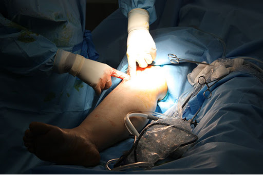 جراحی پای پرانتزی در کودکان