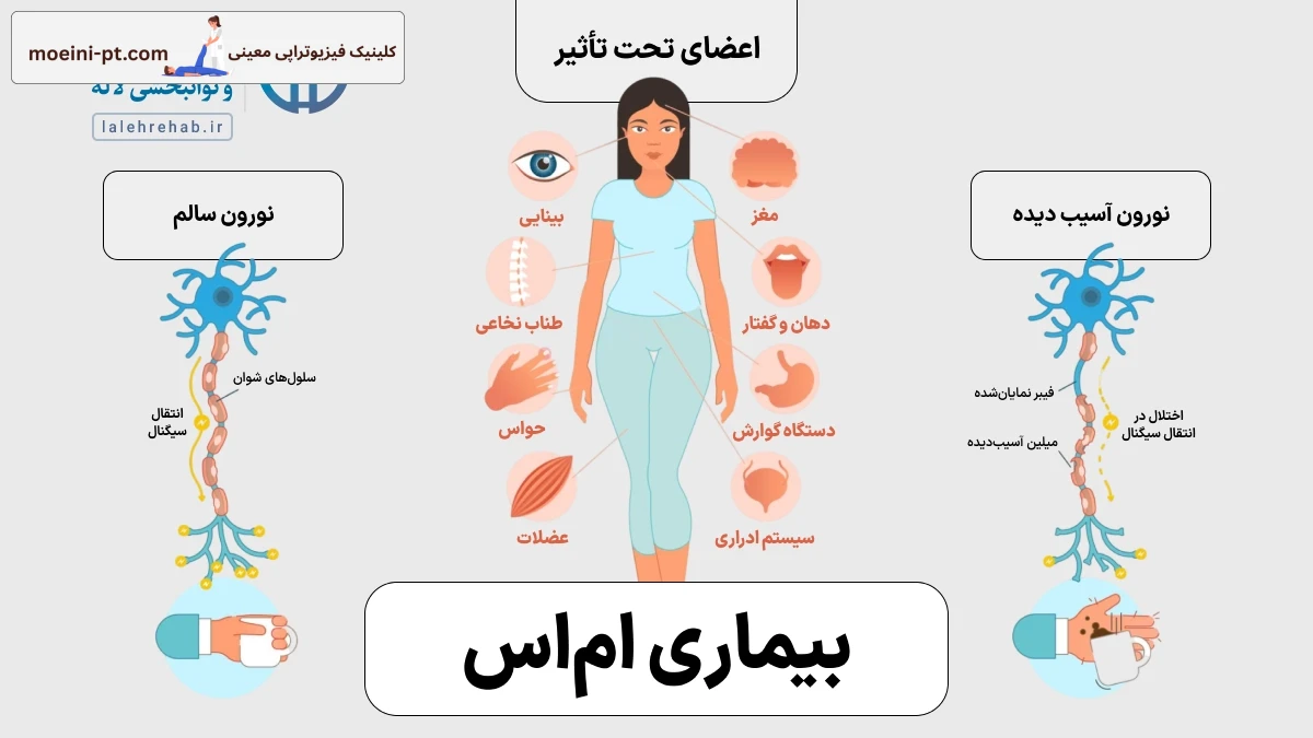 مولتیپل اسکلروزیس چه اعضایی از بدن را تحت تاثیر قرار میدهد؟
