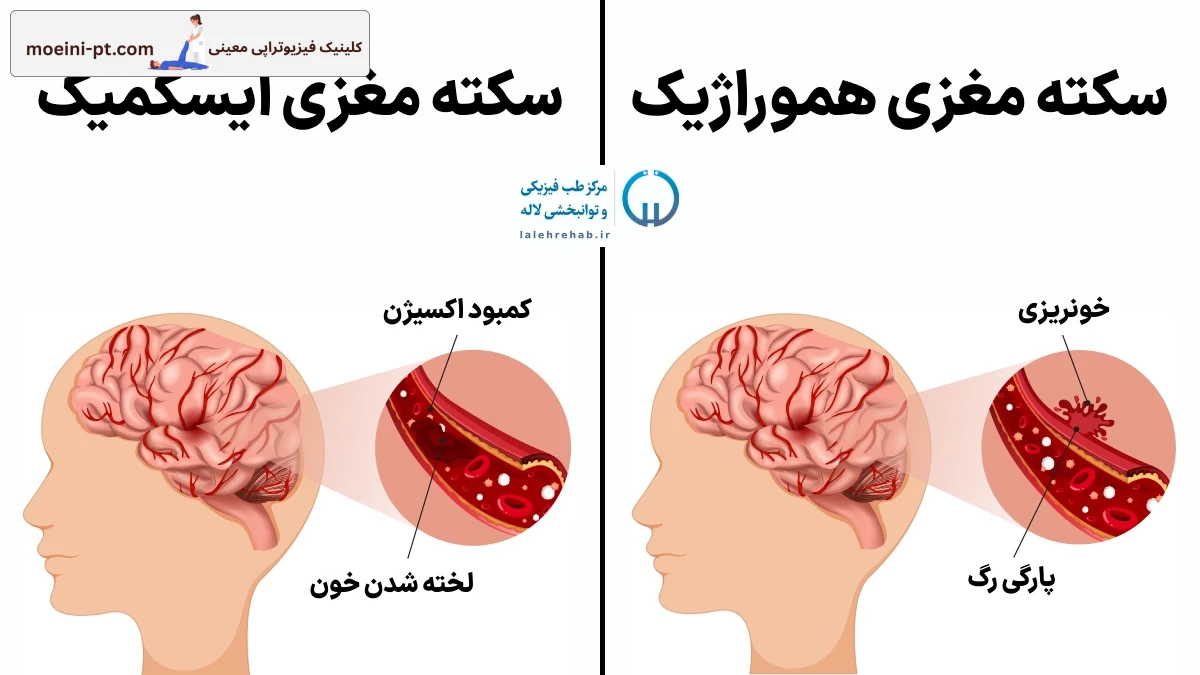 انواع سکته مغزی
