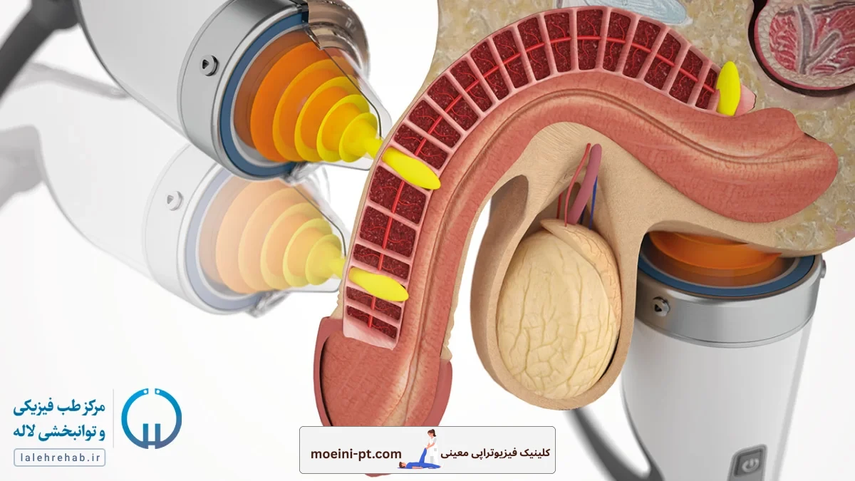 درمان اختلال نعوظ با شاک ویو درمانی