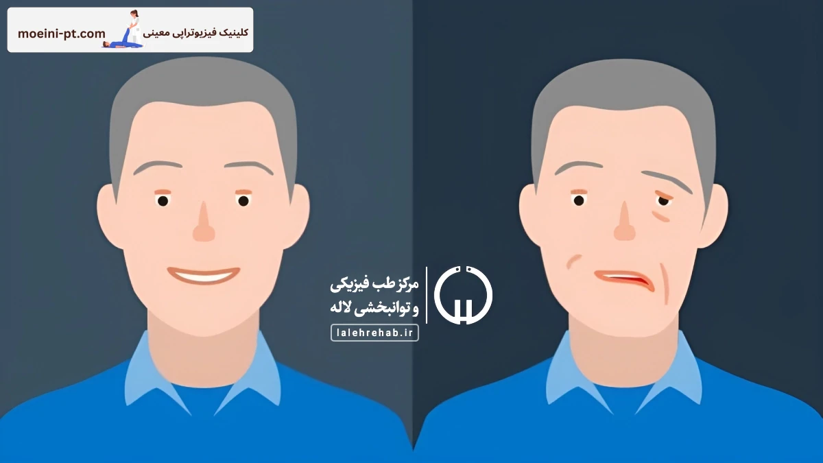 درمان فلج بلز با فیزیوتراپی