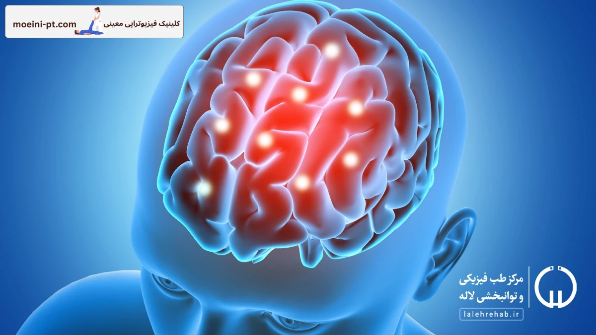 سکته مغزی چیست؟