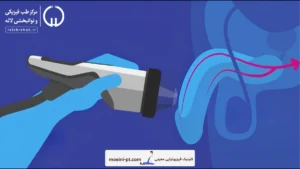 شاک ویو تراپی اختلال نعوظ