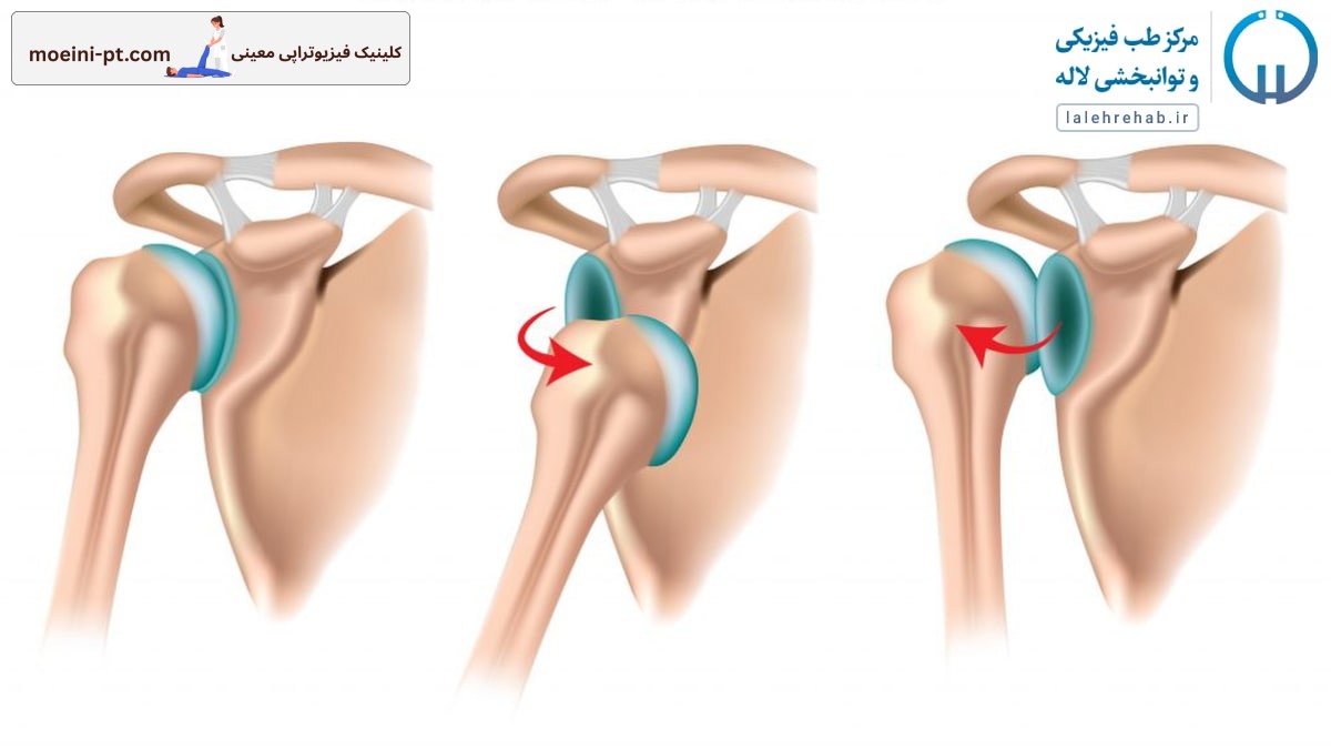 علائم دررفتگی مکرر کتف
