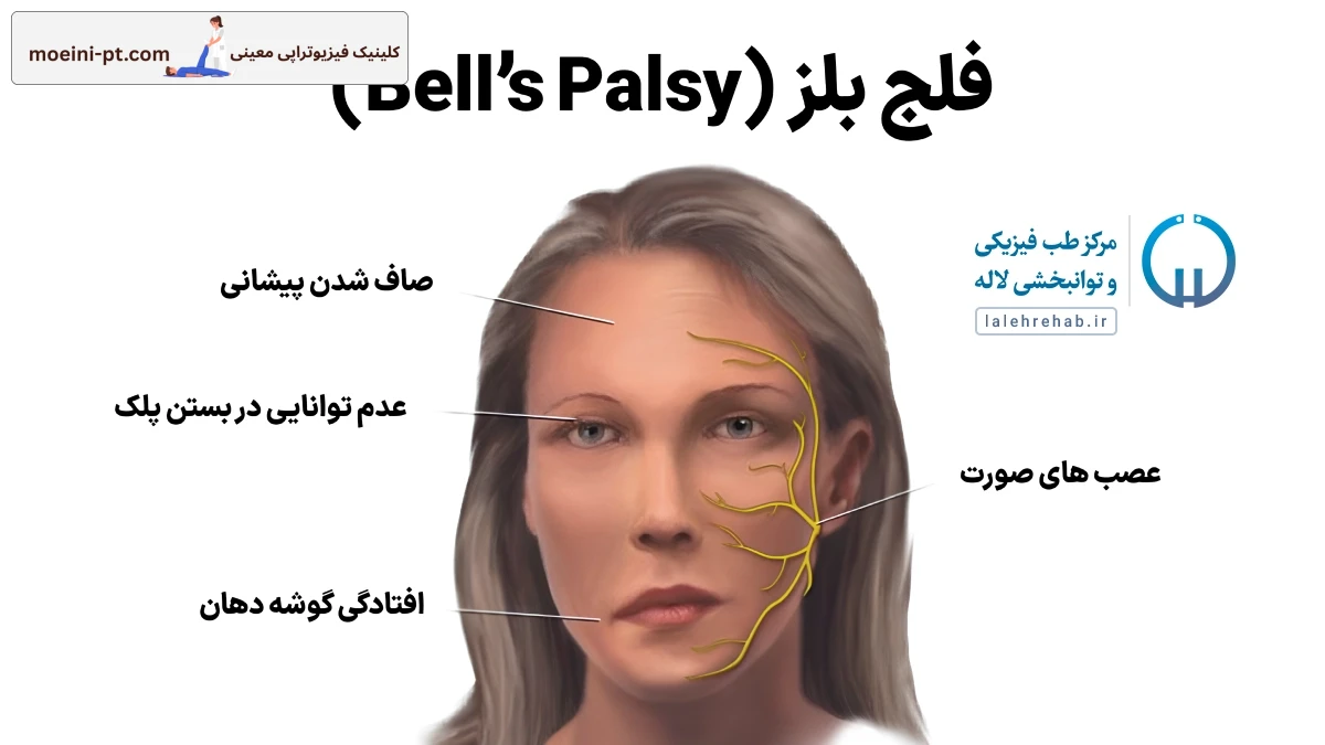 علایٔم فلج بلز 