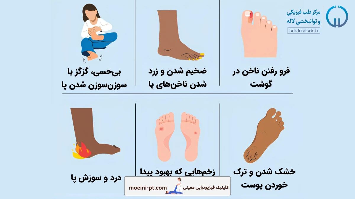 علائم نوروپاتی دیابتی