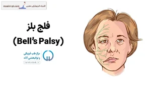 فلج بلز چیست؟ علائم، عوارض، راههای درمان