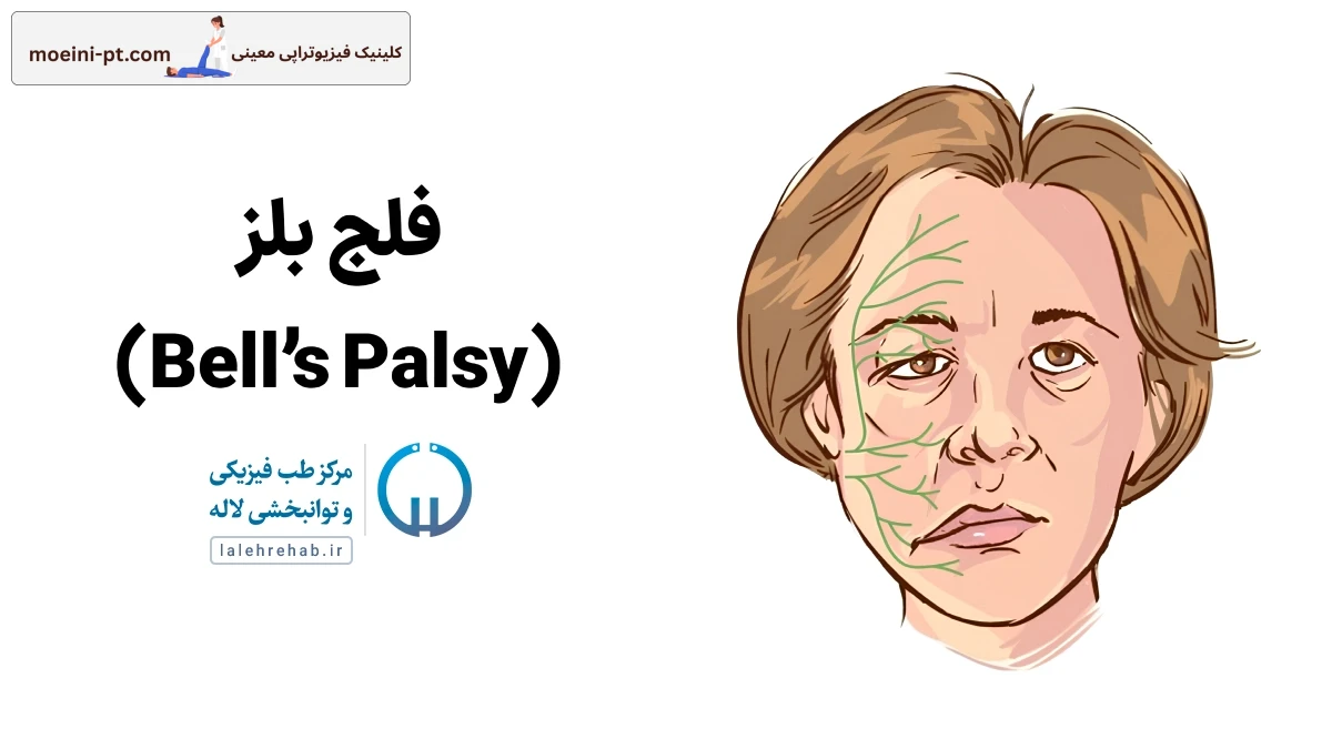 فلج بلز چیست؟ علائم، عوارض، راه‌های درمان